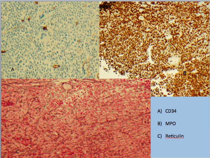 IHC for MPO shows myeloid hyperplasia.  IHC for CD34 highlights rare scattered blats (1-2% of bone marrow cellularity).  A reticulin stain highlights mild reticulin fibrosis